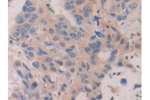 Detection of CHRD in Human Breast cancer Tissue using Polyclonal Antibody to Chordin (CHRD)