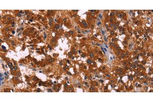 Immunohistochemistry of paraffin-embedded Human thyroid cancer using RPSA Polyclonal Antibody at dilution of 1:60 (RPSA/Laminin Receptor anticorps)