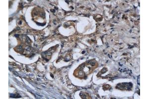 Formalin-fixed and paraffin embedded human colorectal cancer labeled with Anti Legumain Polyclonal Antibody, Unconjugated  followed by conjugation to the secondary antibody and DAB staining