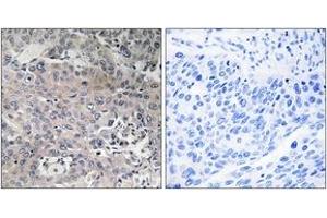 Immunohistochemistry analysis of paraffin-embedded human breast carcinoma tissue, using TUFM Antibody. (TUFM anticorps  (AA 301-350))