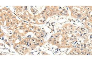 Immunohistochemistry of paraffin-embedded Human lung cancer tissue using SLC27A1 Polyclonal Antibody at dilution 1:40 (SLC27A1 anticorps)