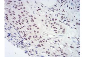 Immunohistochemical analysis of paraffin-embedded esophageal cancer tissues using CBX3 mouse mAb with DAB staining. (CBX3 anticorps  (AA 1-183))