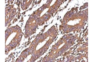 IHC-P Image Immunohistochemical analysis of paraffin-embedded human colon carcinoma, using Galectin 1, antibody at 1:500 dilution. (LGALS1/Galectin 1 anticorps)