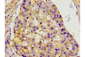 Immunohistochemistry of paraffin-embedded human breast cancer using ABIN7153843 at dilution of 1:100 (GANP anticorps  (AA 292-435))