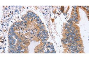 Immunohistochemistry of paraffin-embedded Human colon cancer using CD327 Polyclonal Antibody at dilution of 1:70