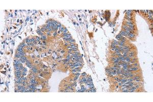 Immunohistochemistry of paraffin-embedded Human colon cancer using CD327 Polyclonal Antibody at dilution of 1:70 (SIGLEC6 anticorps)