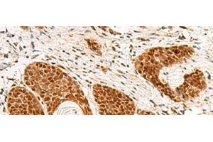 Immunohistochemistry of paraffin-embedded Human esophagus cancer tissue using POM121 Polyclonal Antibody at dilution of 1:75(x200) (POM121 anticorps)