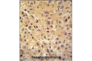 WBSCR27 antibody (N-term) (ABIN654505 and ABIN2844234) immunohistochemistry analysis in formalin fixed and paraffin embedded human hepatocarcinoma followed by peroxidase conjugation of the secondary antibody and DAB staining.