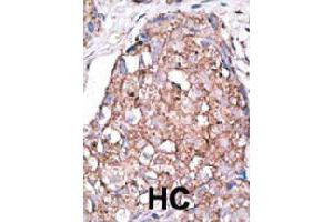 Formalin-fixed and paraffin-embedded human hepatocellular carcinoma tissue reacted with SIGLEC7 polyclonal antibody  , which was peroxidase-conjugated to the secondary antibody, followed by AEC staining. (SIGLEC7 anticorps  (C-Term))
