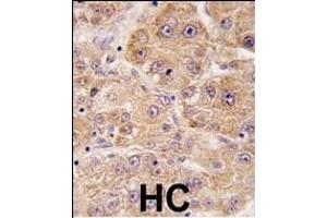 Formalin-fixed and paraffin-embedded human hepatocarcinoma tissue reacted with hUVRAG (C-term), which was peroxidase-conjugated to the secondary antibody, followed by DAB staining. (UVRAG anticorps  (C-Term))