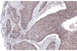 IHC-P Image Immunohistochemical analysis of paraffin-embedded lung SCC xenograft, using MAPK8IP1, antibody at 1:100 dilution. (MAPK8IP1 anticorps)