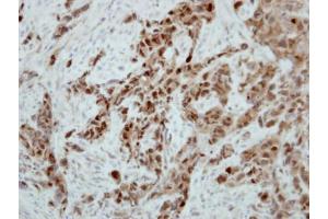 IHC-P Image Immunohistochemical analysis of paraffin-embedded H661 xenograft, using Ataxin 3, antibody at 1:500 dilution. (Ataxin 3 anticorps)