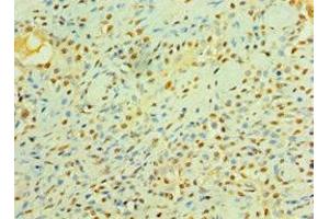 Immunohistochemistry of paraffin-embedded human breast cancer using ABIN7158358 at dilution of 1:100