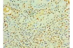 Immunohistochemistry of paraffin-embedded human breast cancer using ABIN7158358 at dilution of 1:100 (LIMK2 anticorps  (AA 1-240))