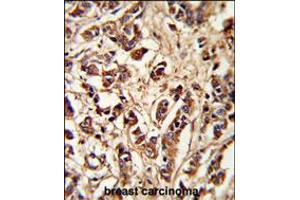 Formalin-fixed and paraffin-embedded human breast carcinoma reacted with PCM-1 Antibody , which was peroxidase-conjugated to the secondary antibody, followed by DAB staining. (PCM1 anticorps  (AA 632-661))