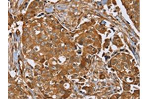 The image on the left is immunohistochemistry of paraffin-embedded Human breast cancer tissue using ABIN7192090(RAB14 Antibody) at dilution 1/40, on the right is treated with synthetic peptide. (RAB14 anticorps)