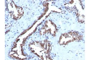 Formalin-fixed, paraffin-embedded human Prostate Carcinoma stained with Cyclin B1 Mouse Monoclonal Antibody (CCNB1/1098).