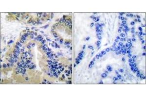 Immunohistochemistry analysis of paraffin-embedded human lung carcinoma tissue, using Caspase 10 Antibody. (Caspase 10 anticorps  (AA 430-479))