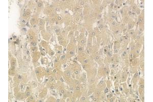 ABIN6265547 and ABIN6276370 at 1/100 staining human hepatocellular carcinoma by IHC-P. (TGFA anticorps  (C-Term))