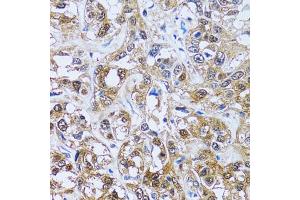 Immunohistochemistry of paraffin-embedded human liver cancer using IMPA1 antibody (ABIN5973786) at dilution of 1/100 (40x lens).