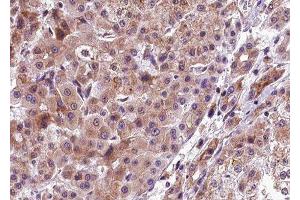 ABIN6277783 at 1/100 staining human liver carcinoma tissue sections by IHC-P. (PERK anticorps  (pThr982))