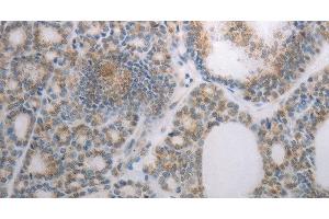 Immunohistochemistry of paraffin-embedded Human thyroid cancer using RBMS3 Polyclonal Antibody at dilution of 1:70 (RBMS3 anticorps)