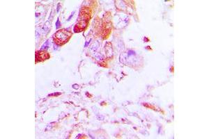 Immunohistochemical analysis of Aquaporin 5 staining in human lung cancer formalin fixed paraffin embedded tissue section.