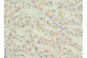 Immunohistochemistry of paraffin-embedded human gastric cancer using ABIN7164276 at dilution of 1:100 (PRICKLE2 anticorps  (AA 615-844))
