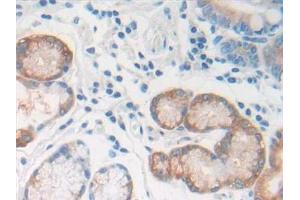 Detection of REG1b in Human Stomach cancer Tissue using Polyclonal Antibody to Regenerating Islet Derived Protein 1 Beta (REG1b)