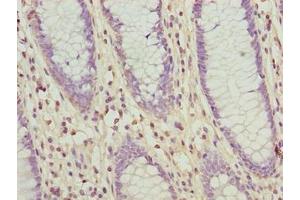 Immunohistochemistry of paraffin-embedded human colon cancer using ABIN7176680 at dilution of 1:100 (SLC3A6 (AA 246-461) anticorps)