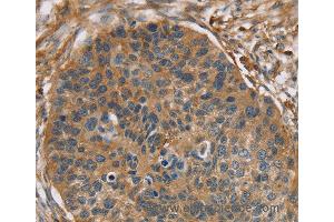 Immunohistochemistry of Human breast cancer using RIPK4 Polyclonal Antibody at dilution of 1:40 (RIPK4 anticorps)