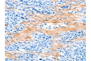 The image on the left is immunohistochemistry of paraffin-embedded Human esophagus cancer tissue using ABIN7189570(AARS Antibody) at dilution 1/50, on the right is treated with synthetic peptide.