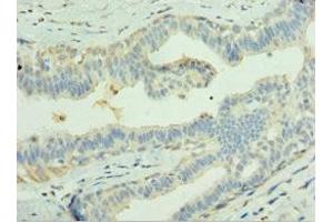 Immunohistochemistry of paraffin-embedded human breast cancer using ABIN7158044 at dilution of 1: 100 (LGI1 anticorps  (AA 35-285))