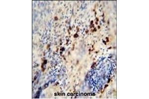 LCE1A antibody (C-term) (ABIN654845 and ABIN2844511) immunohistochemistry analysis in formalin fixed and paraffin embedded human skin carcinoma followed by peroxidase conjugation of the secondary antibody and DAB staining. (LCE1A anticorps  (C-Term))