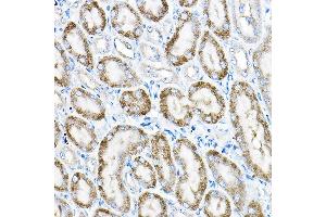 Immunohistochemistry of paraffin-embedded human liver cancer using  Rabbit pAb (ABIN6131168, ABIN6136442, ABIN6136443 and ABIN6224114) at dilution of 1:25 (40x lens). (ACOX1 anticorps  (AA 1-270))
