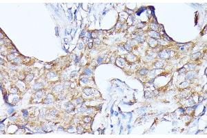 Immunohistochemistry of paraffin-embedded Human breast cancer using CTSF Polyclonal Antibody at dilution of 1:100 (40x lens). (Cathepsin F anticorps)