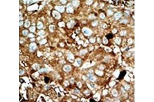 IHC analysis of FFPE human hepatocarcinoma tissue stained with the PFKFB3 antibody (PFKFB3 anticorps  (AA 454-484))