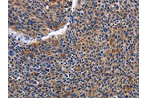 The image on the left is immunohistochemistry of paraffin-embedded Human liver cancer tissue using ABIN7129821(IGSF10 Antibody) at dilution 1/50, on the right is treated with fusion protein. (IGSF1 anticorps)