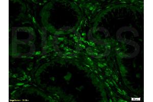 Formalin-fixed and human colon carcinoma tissue labeled with Anti-Phospho-IKK alpha beta (Ser176 Ser180) Polyclonal Antibody, unconjugated (ABIN685183) at 1: 200 followed by incubation with conjugated secondary antibody, Goat Anti-Rabbit IgG, FITC conjugated  ,