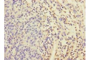Immunohistochemistry of paraffin-embedded human bladder cancer using ABIN7152192 at dilution of 1:100 (EIF4E2 anticorps  (AA 1-240))