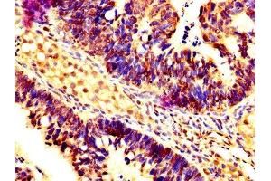 IHC image of ABIN7146960 diluted at 1:200 and staining in paraffin-embedded human ovarian cancer performed on a Leica BondTM system.