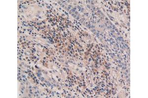 IHC-P analysis of skin cancer tissue, with DAB staining. (CASP5 anticorps  (AA 145-327))