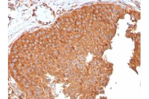 Formalin-fixed, paraffin-embedded human Urothelial Carcinoma stained with PAI-RBP1 Mouse Monoclonal Antibody (SERBP1/3496).