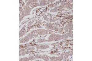 Immunohistochemical analysis of A on paraffin-embedded Human breast carcinoma tissue. (ENOX2 anticorps  (N-Term))