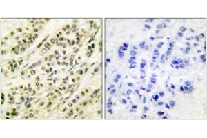 Immunohistochemistry analysis of paraffin-embedded human breast carcinoma tissue, using SKP1A/p19 Antibody.