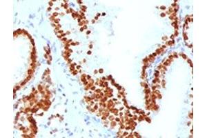 IHC testing of FFPE human prostate carcinoma with FOXA1 antibody. (FOXA1 anticorps  (AA 372-472))