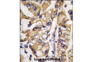 Formalin-fixed and paraffin-embedded human lung carcinoma tissue reacted with HDBP1 Antibody , which was peroxidase-conjugated to the secondary antibody, followed by DAB staining. (SLC2A4RG anticorps  (AA 213-242))