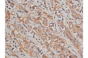 ABIN6269036 at 1/200 staining human breast cancer tissue sections by IHC-P.