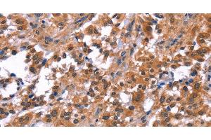 Immunohistochemistry of paraffin-embedded Human thyroid cancer tissue using PIP5K1B Polyclonal Antibody at dilution 1:30