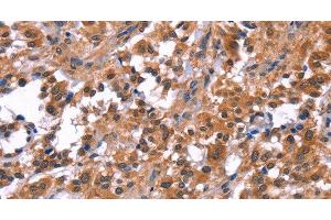 Immunohistochemistry of paraffin-embedded Human thyroid cancer tissue using PIP5K1B Polyclonal Antibody at dilution 1:30 (PIP5K1B anticorps)